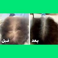 درمان ریزش و کمپشتی مو ، ریش و سبیل با سرم سیر سیاه