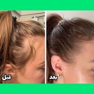 پک محصولات درمان ریزش مو و پرپشت شدن مو در یک ماه