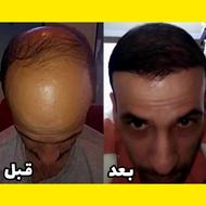 پک تِریمون قطع ریزش و رویش مجدد مو