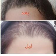تونیک ضد ریزش