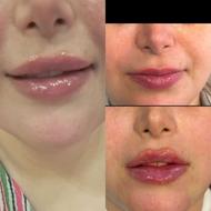 ژل و بوتاکس و مزو و جوانساز با بهترین متریال و کمترین قیمت