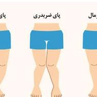 کلینیک ارتوپدی درمان زانوهای پرانتزی و ضربدری