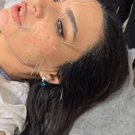 طب سوزنی لاغری امبدینگ