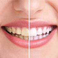 خدمات تخصصی بلیچینگ