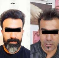کاشت مو.تخفیف ویژه