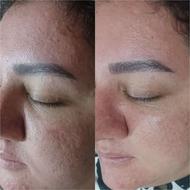 مزونیدلینگ تخصصی