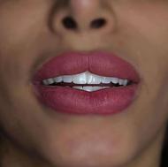 کامپوزیت /لمینیت/روکش/شرایطی