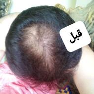 ضد ریزش ارثی/رشد مجدد مو/تونیک تقویت مو