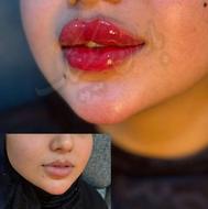 ژل بوتاکس چال لپ مزوتراپی خال برداری