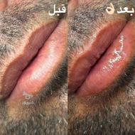 رفع کبودی لب