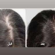 ریزش مو داری نگران نباش