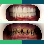 کامپوزیت ایمپلنت لمینت اقساط ویژه