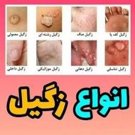 درمان ریشه ای زگیل تناسلی (HPV و HSV)