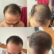 پرپشتی مو تضمینی