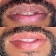 رفع کبودی و تیرگی لب