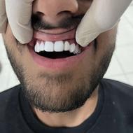 کامپوزیت دندان مصنوعی پرکردن دندان روکش