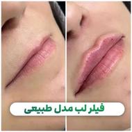 تزریق ژل و بوتاکس