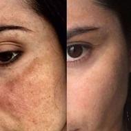 ضدلک وروشن کننده قوی