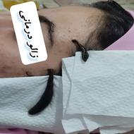 حجامت فصد خون زالو درمانی