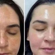 پاک کنند قوی لکّه ص و ر ت100%تضمینی سبزه ای سفیدشو