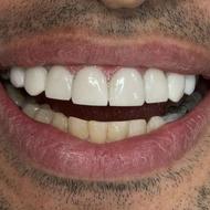 تخفیف کامپوزیت