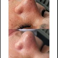 پاکسازی/فشیال/کربوکسی تراپی
