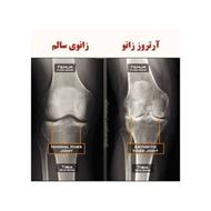 بهبودی آرتروز و التهابات مفاصل و دیسک