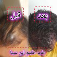 پک ضد ریزش طبیعی و تضمینی شامل یک محلول و یک شامپو تقویتی