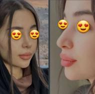 لیفت بینی بدون جراحی در خانه