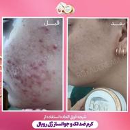 کرم ضد لکو جوش