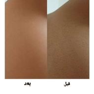 به مناسبت افتتاحیه لیزر کل بدن تا آخرین روز خدمات 550