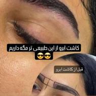 کاشت مو و کاشت ابرو
