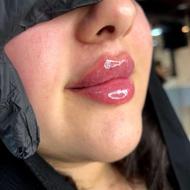 فیلرژل بوتاکس،کربوکسی،مزوفیشیال،ریموتتوخال نخ