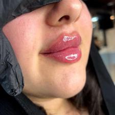 فیلرژل بوتاکس،کربوکسی،مزوفیشیال،ریموتتوخال نخ