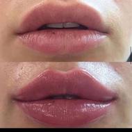 تزریق ژل وبوتاکس انواع کوکتل چربی سوز و ضد اسکار