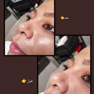 تخفیف ویژه فیشال تخصصی و احیای پوست