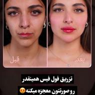 جشنواره ژل و بوتاکس با قیمت استثنایی/اقساطی