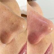 فیشال، پاکسازی صورت