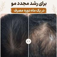 ریزش مو داری ؟ ریزش موی سکه ای داری ؟