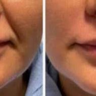 تزریق ژل لب و گونه خط خنده فقط یک میلیون