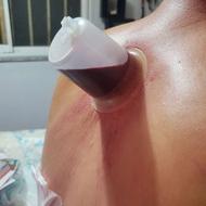 طب سنتی ماساژ تراپی حجامت زالو درمانی طب سوزنی