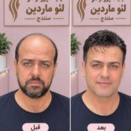 کلینیک پروتز مو لئو ماردین