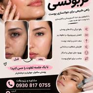 کربوکسی|فشیال